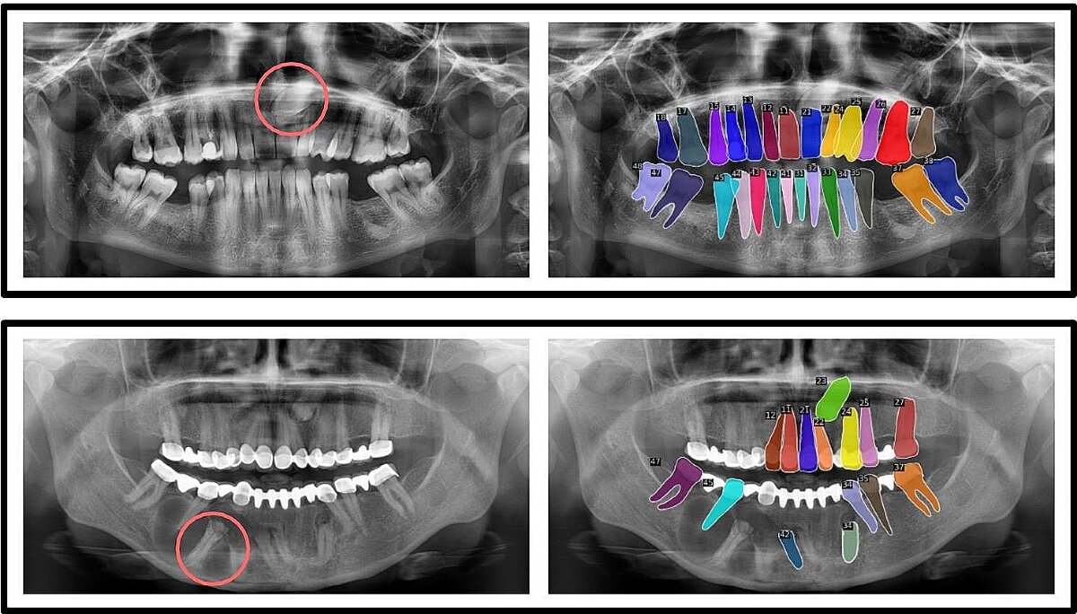 Radiografie analizată de asistentul AI Planodent — dinți numerotați FDI, segmentați color și zone de atenție marcate